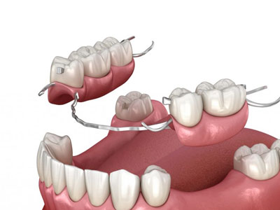 protesi dentali combinate